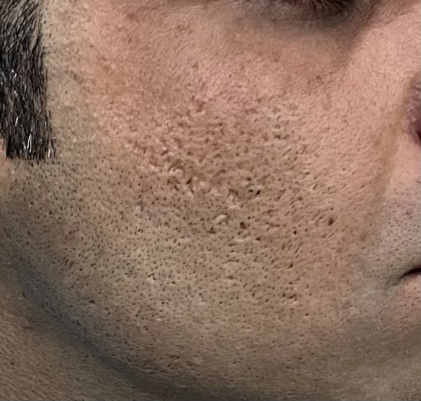 Melasma / Hyperpigmentation